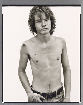 A black-and-white portrait photograph of a shirtless White man with an acne-scarred face, long  wavy hair, wearing jeans, and with one hand wrapped in bandages.