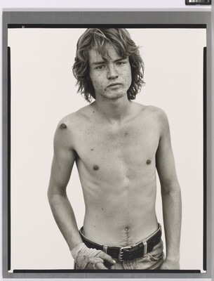 A black-and-white portrait photograph of a shirtless White man with an acne-scarred face, long  wavy hair, wearing jeans, and with one hand wrapped in bandages.